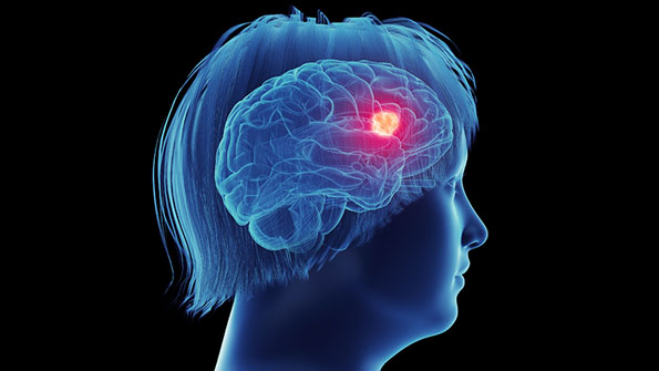 Brain metastasis in a female patient